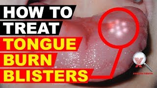 HOW TO TREAT TONGUE BURN BLISTERS  XTREME TRUTH DIGESTIVE SYSTEM HEALTH TIPS  ORAL TREATMENT [upl. by Auliffe]