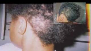 Reverse Traction Alopecia ReGrow Your Hair Naturally [upl. by Imiaj448]