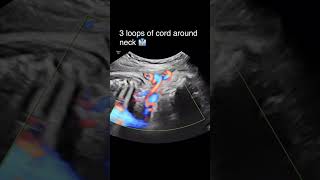 Cord around neck baby movement in womb pregnancycare pregnancy ultrasound [upl. by Nitsuj]