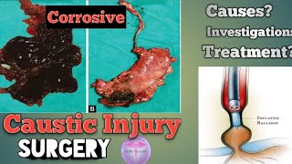 Caustic Injury and Corrosive Injury Emergency treatment Upper GIT dr surgery [upl. by Cantu]