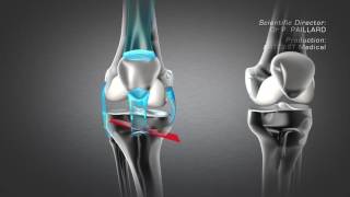 Tibial Valgus Osteotomy [upl. by Ientruoc]