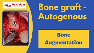 Autogenous Bone Grafts [upl. by Lertnek]