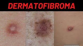 Dermatofibroma Causes Symptoms What is it How is it treated Benign Fibrous Histiocytoma [upl. by Rizan]