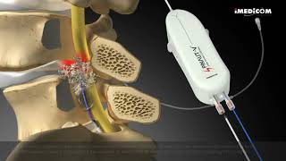 IMEDICOMs product Steerable Video Guided Catheter SpinautV [upl. by Enobe267]