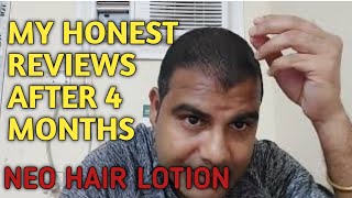 my honest reviews after 4 months  neo hair Lotion review after 4 months  neo hair lotion review [upl. by Naj]