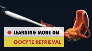 ✅ Oocyte Retrieval [upl. by Bully177]