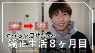 8ヶ月間歯列矯正した経過と感想を語ります。 [upl. by Crooks]