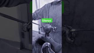 uterus fibroiduterus uterustransplant retroverteduterus shortsfeed shortvideo [upl. by Ahsehat]