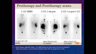 Imaging in neuroendocrine tumor [upl. by Chaffee]