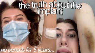 getting my implant removed AND REPLACED after 5 years my experience [upl. by Miun]