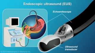 Understanding EUSFNA [upl. by Seraphine]