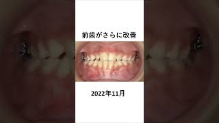 反対咬合の子供の矯正治療 矯正歯科 dentist 歯列矯正 [upl. by Munshi]