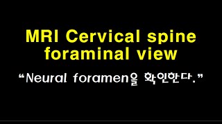 MRI Cervical spine foraminal view [upl. by Leiahtan]