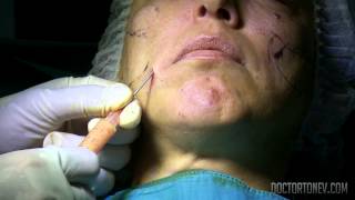 Липофилинг на лице  др Антон Тонев Face Lipofilling [upl. by Byrle]