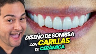 PROCEDIMIENTO de CARILLAS DENTALES DE CERÁMICA BIEN HECHAS ¡DISEÑO DE SONRISA Antes y Después [upl. by Ane]