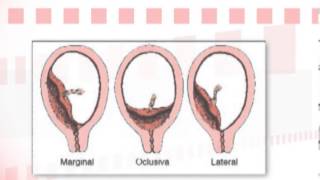 Dr Ignacio Pérez Tomasone ¿Qué es la placenta previa [upl. by Judith]