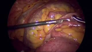 Laparoscopic management of Adhesive Band small bowel obstruction [upl. by Yonita616]