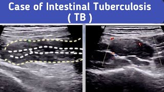 Ultrasound Intestinal Tuberculosis TB [upl. by Roley132]