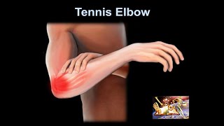 Tennis Elbow why it hurts Everything You Need To Know  Dr Nabil Ebraheim [upl. by Cornelle]