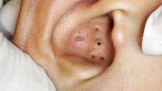 Big Cystic Acne Blackheads Extraction Blackheads amp Milia Whiteheads Removal Pimple Popping  5217 [upl. by Luhey]