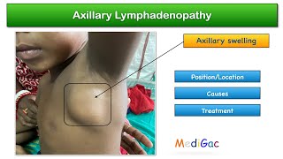 Axillary lymphadenopathy  Location amp Position  Causes  Treatment [upl. by Leandra]