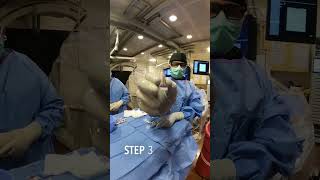 Live Kidney AML Angiomyolipoma Embolization Treatment Doctor [upl. by Edveh522]