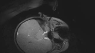 MRIGuided Injection Procedures of the Temporomandibular Joints in Children and Adults 2 of 3 [upl. by Wendy]