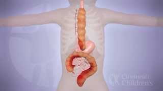 LongSegment Colonic Interposition for Esophageal Atresia 3D Animation [upl. by Arrad]