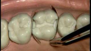 Dentsply  Palodent Demonstration on a dental model [upl. by Leahplar845]