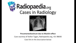 Pneumomediastinum due to Macklin effect Radiopaediaorg Cases in Radiology [upl. by Lowenstern]