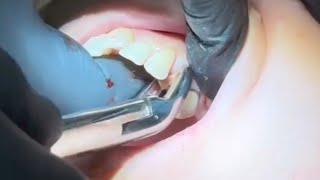 Extraction for First Maxillary Premolar [upl. by Rohn]