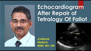 Echocardiogram After Repair of Tetralogy Of Fallot [upl. by Oag]