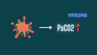 Hypercapnia Pathophysiology Of CO2 Retention [upl. by Lahtnero571]