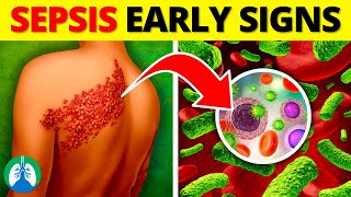 Top 10 Early Warning Signs of Sepsis  NEVER Ignore THIS [upl. by Martainn]