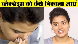 How to Remove Blackheads from Nose  Face Hindi [upl. by Kcirddet]