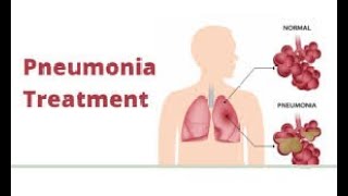 Pneumonia Causes Symptoms Diagnosis amp Treatment [upl. by Haet]