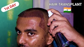 First Day After Hair Transplant in Delhi  Best Hair Transplant  From Hair Loss to Confidence [upl. by Nos]