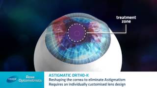 Astigmatism and Orthokeratology  Can Orthokeratology correct Astigmatism  Rose Optometrists [upl. by Yordan]