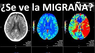 Se puede ver DOLOR de CABEZA o MIGRAÑA en resonancia o TAC [upl. by Prakash]