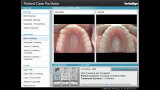 Invisalign Mild Crowding [upl. by Mairem]