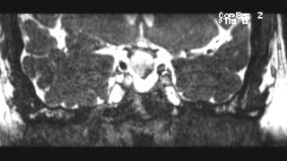 Craniopharyngioma adamantinomatous [upl. by Abott]