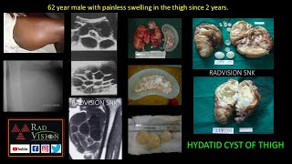 Hydatid cysts Imaging and complications [upl. by Enived]