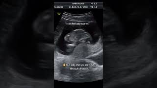 Baby movement in womb pregnancy ultrasound pregnancycare [upl. by Wylie]