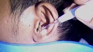 Huge Earwax Blockage Removal [upl. by Bronez569]