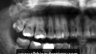 3rd Molar Extractions  Maxillary Molar Apices [upl. by Anal621]