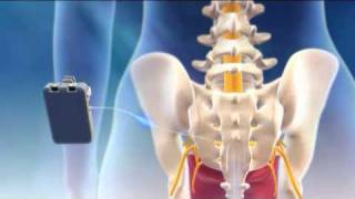 Overview of Sacral Nerve Stimulation for Urinary Control [upl. by Animehliw486]