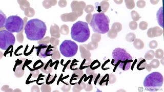 Acute Promyelocytic Leukemia APL microgranular vs classic cottage loaf cells Hematology [upl. by Seeto389]