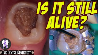 AMAZING Save of A Tooth w A Very BIG and DEEP Cavity 4k C28 [upl. by Sugden880]