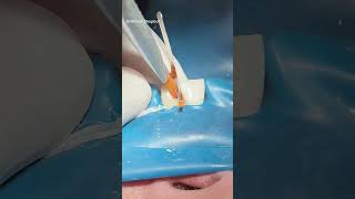 Root canal treatment amp composite restoration dentist [upl. by Asirral890]