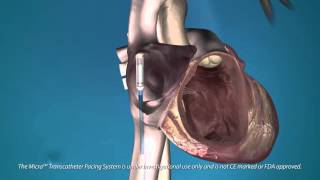 The Medtronic Micra Transcatheter Pacing System [upl. by Millan]